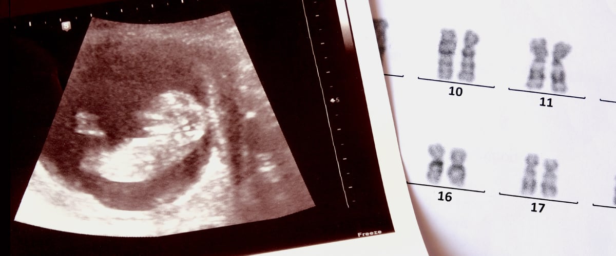 Treating genetic disorders before birth: Prenatal and newborn genetic screening is surging
