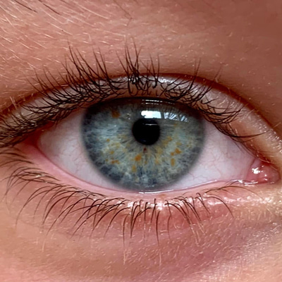 A close up photo of Lisch nodules on the iris