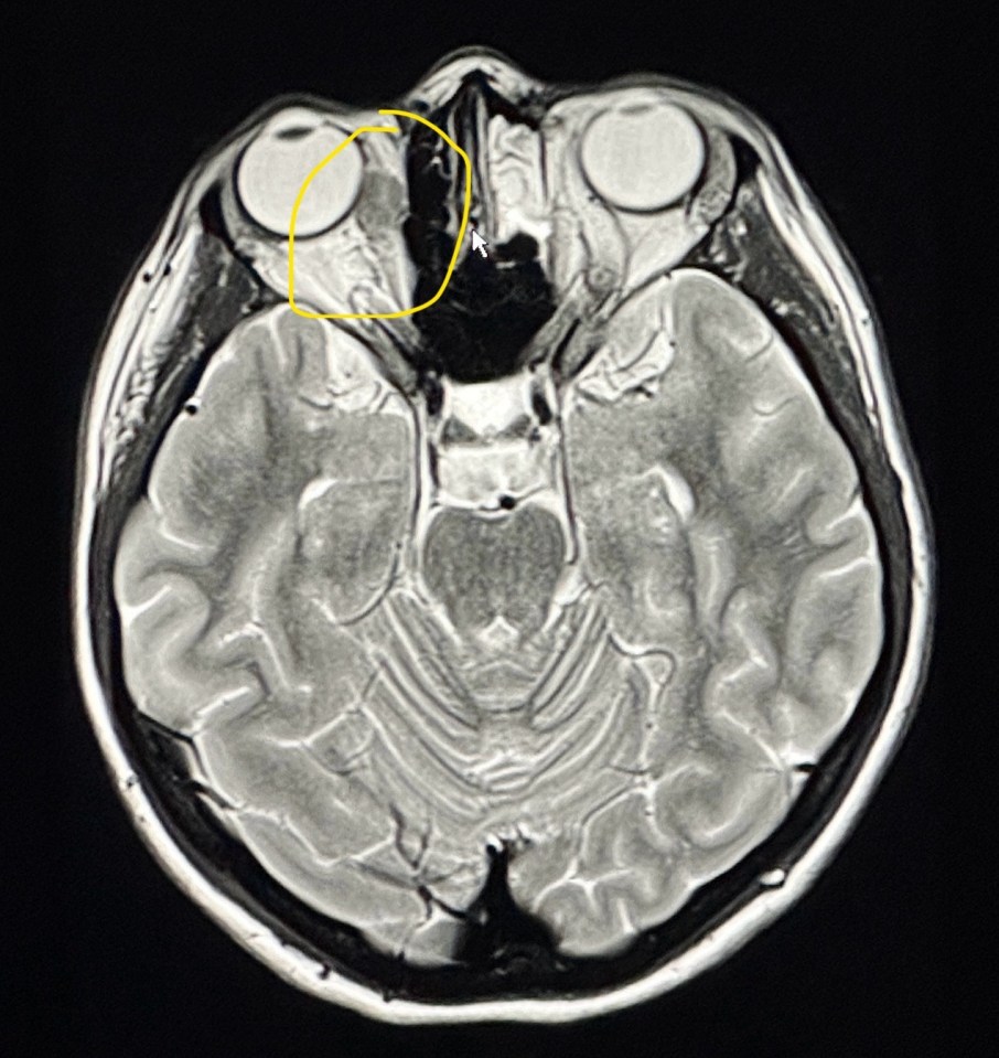Brain scan showing an orbital tumor.