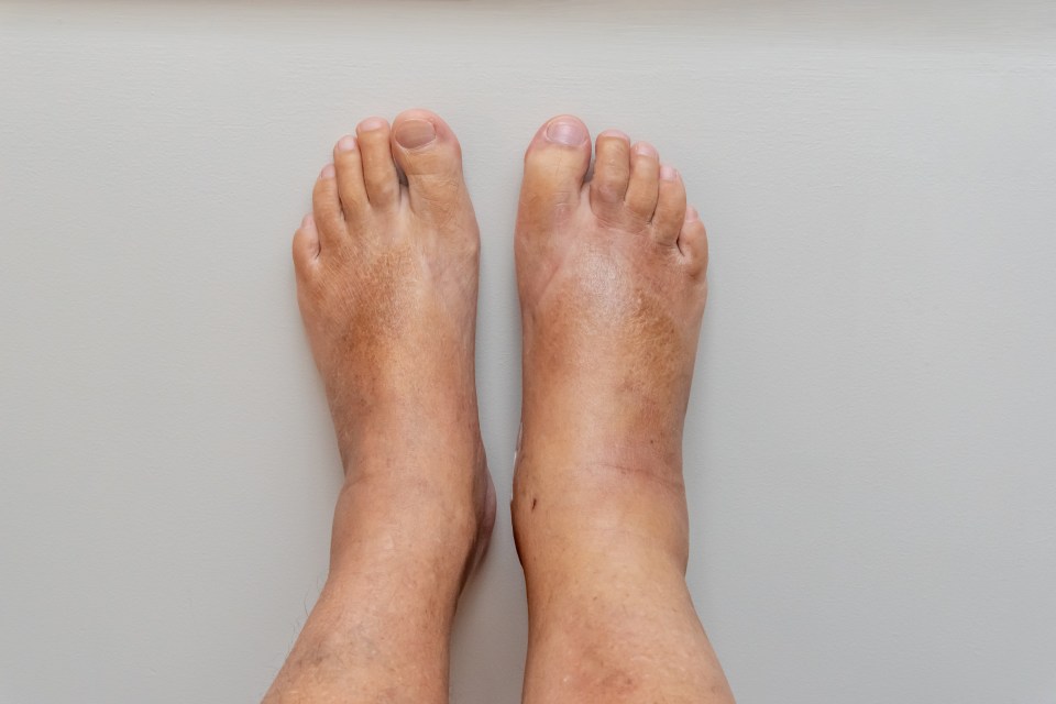Swollen foot, ankle, and leg.