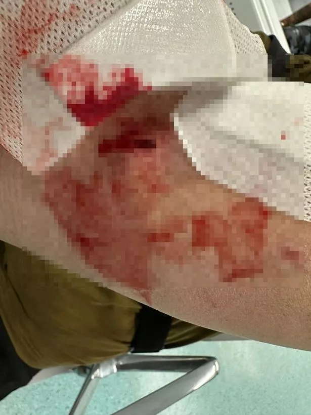 Miro sustained serious deep injuries 