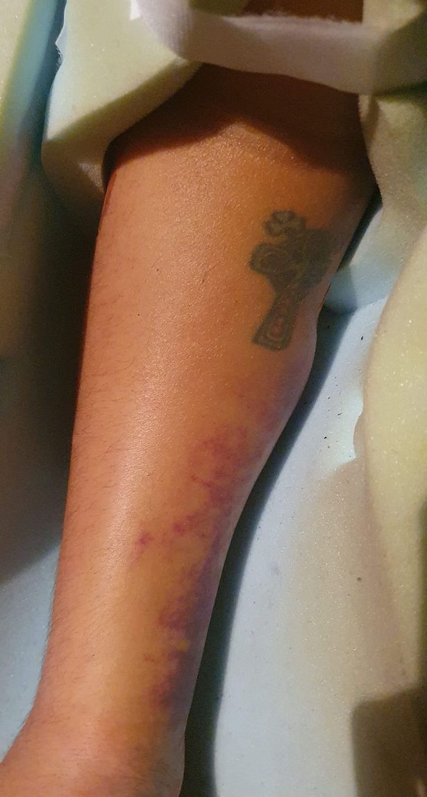 Mr Murphy was left with an eight-inch plate in his arm