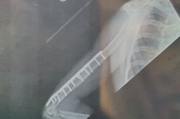 An X-ray of Mr Murphy's breakage