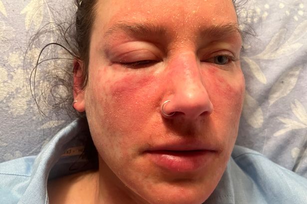 A dark haired woman with a red, swollen face