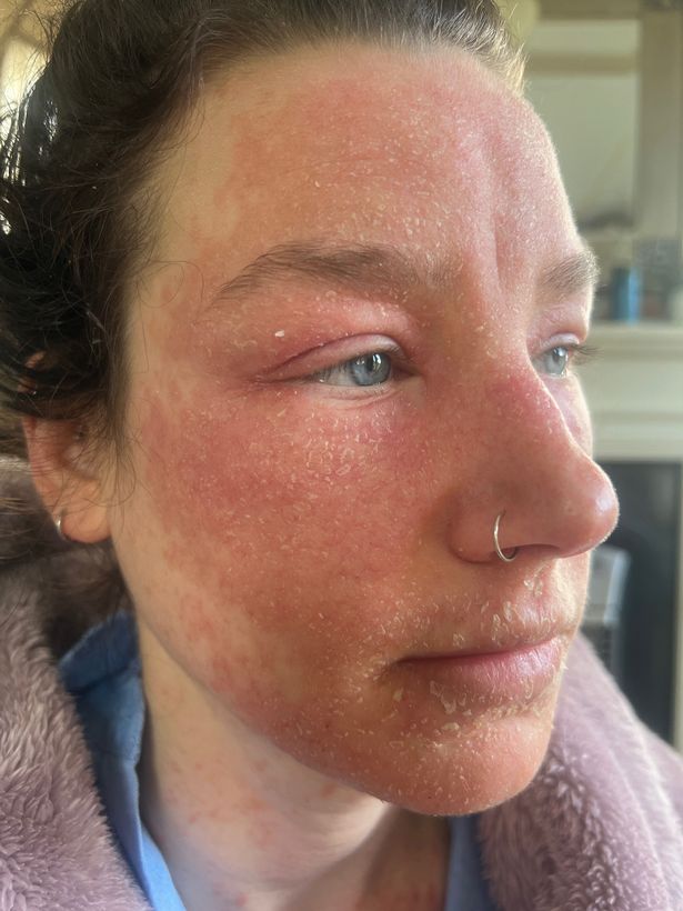 A woman with red and dry skin on her face