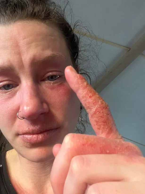 A woman holding up her hand which is bright red, dry and very irritated