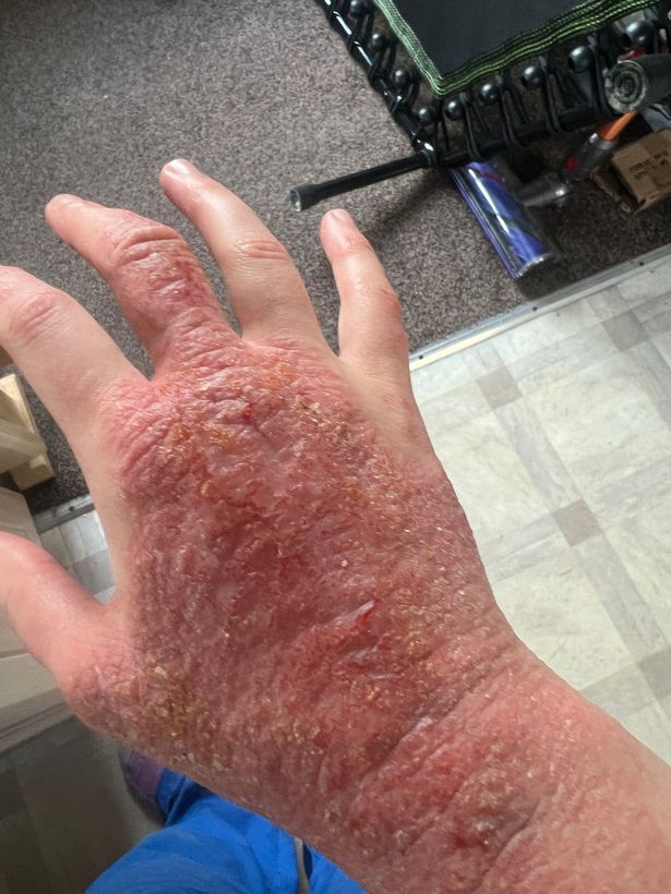 A hand with very dry and red, irritated skin