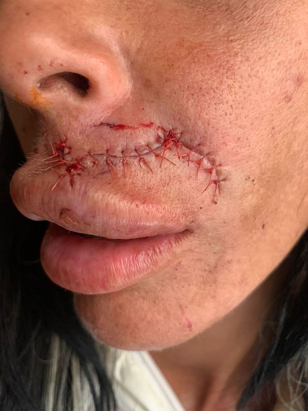 The mum-of-two was scared she might lose her lip following the attack