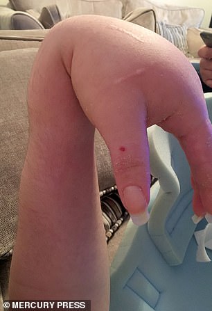 Miss Pohl's infected hand is pictured after the supposed failed cannula insertion. She believes it may have hit a bone or nerve, which caused her hand to swell
