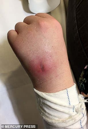 Image shows Miss Pohl's hand after an abscess was drained. She was hospitalised for her pain weeks later