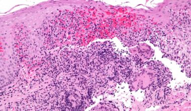 Genetic mutation linked to iron deficiency in Crohn's disease patients