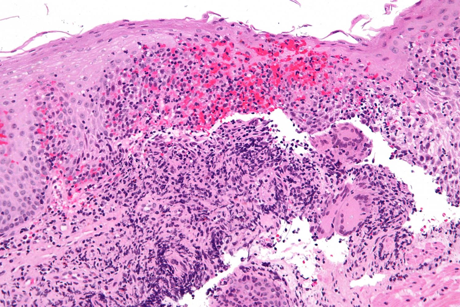Genetic mutation linked to iron deficiency in Crohn's disease patients