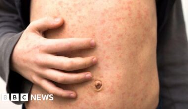 Measles warning to holidaymakers as cases rise across Europe