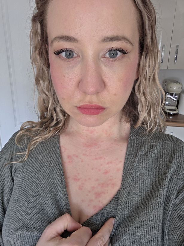 Woman showFrancesca says she had to stay at home for two weeksing a red rash on her chest