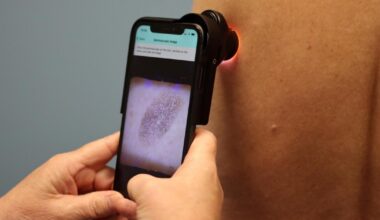 AI being used to speed up diagnosis of skin cancer in Warrington