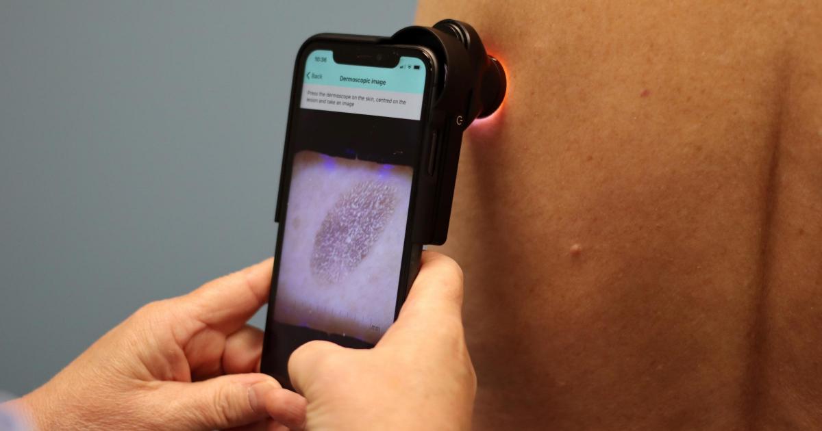 AI being used to speed up diagnosis of skin cancer in Warrington