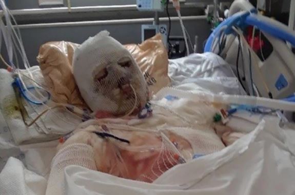 Burn victim in hospital bed with bandages.