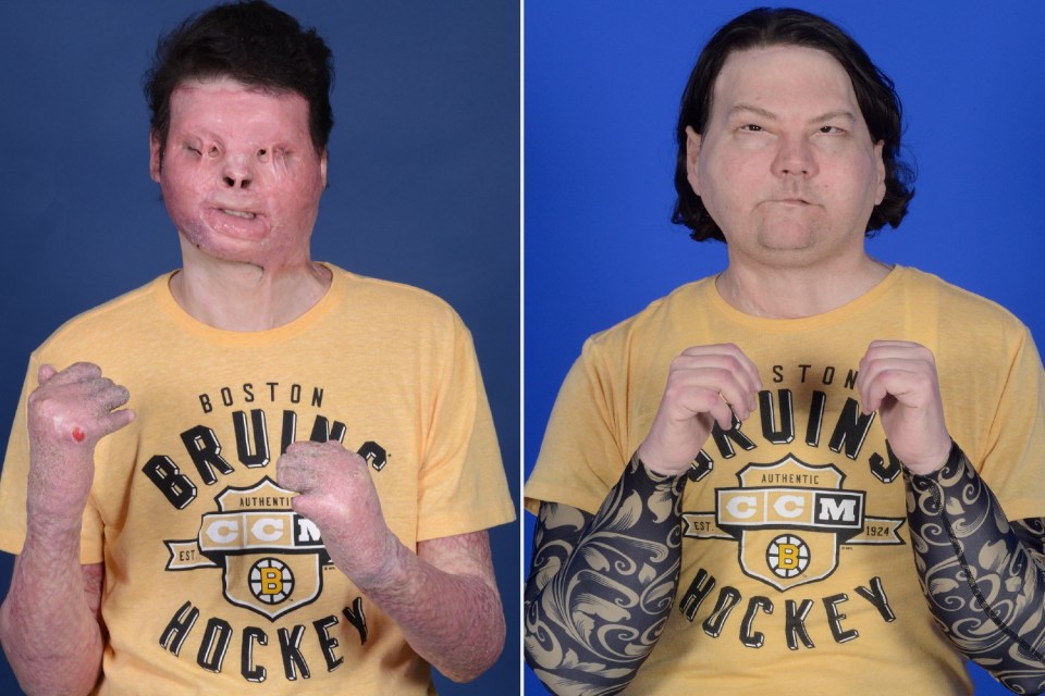 Before and after photos of a man who received a face and hands transplant.