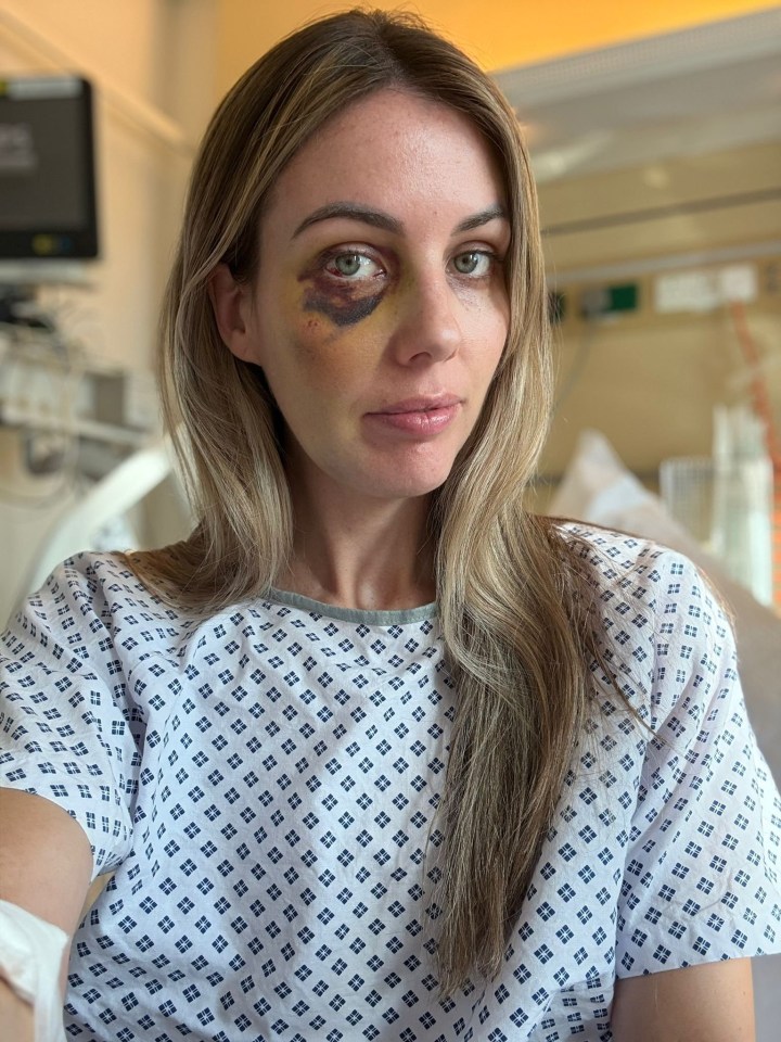 Woman in hospital gown with a large bruise around her eye.
