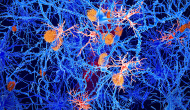 Amyloid and microglia cells in Alzheimer's disease.