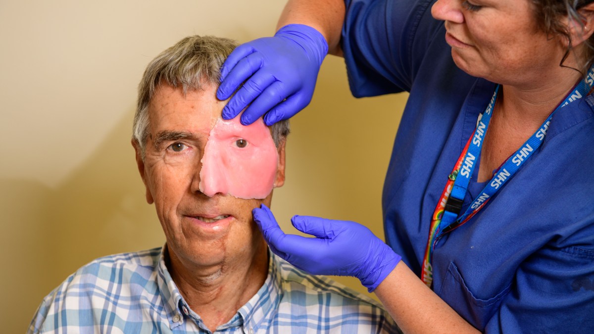 How an NHS team is changing lives — by 3D printing body parts