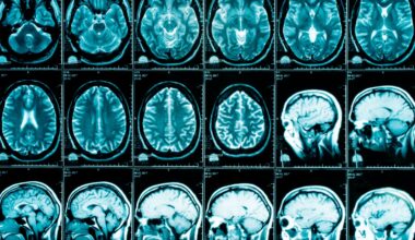 NHS patients denied breakthrough Alzheimer’s drugs