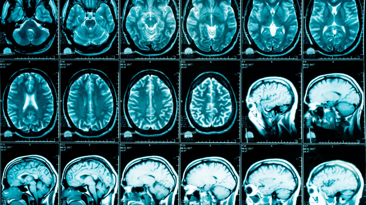 NHS patients denied breakthrough Alzheimer’s drugs