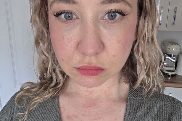 Woman showFrancesca says she had to stay at home for two weeksing a red rash on her chest