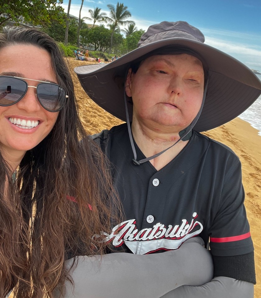 A woman and her boyfriend, who received a face transplant, at the beach.