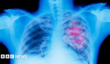 Generic image of an x-ray showing lung cancer in the right lung.