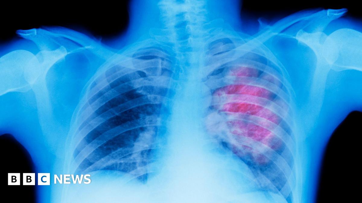 Generic image of an x-ray showing lung cancer in the right lung.