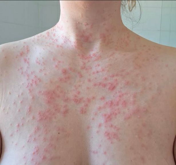 Francesca's rash