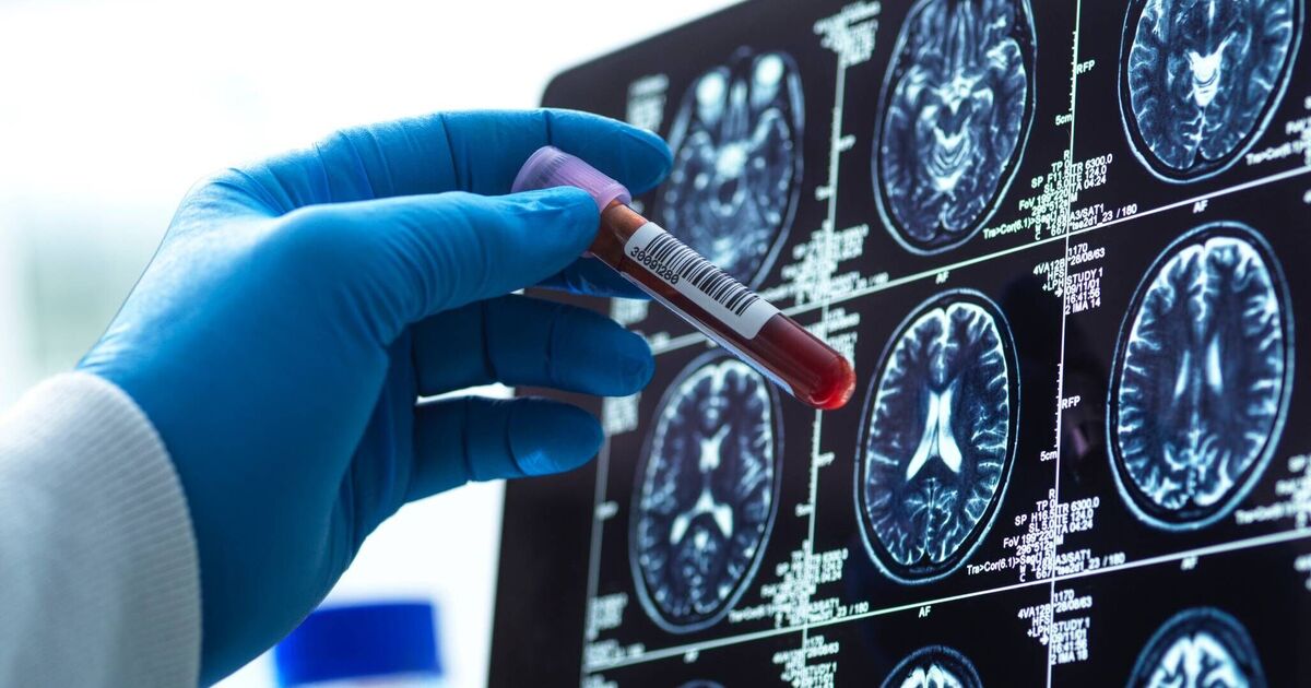 Breakthrough blood test diagnoses Alzheimer's early | Science | News