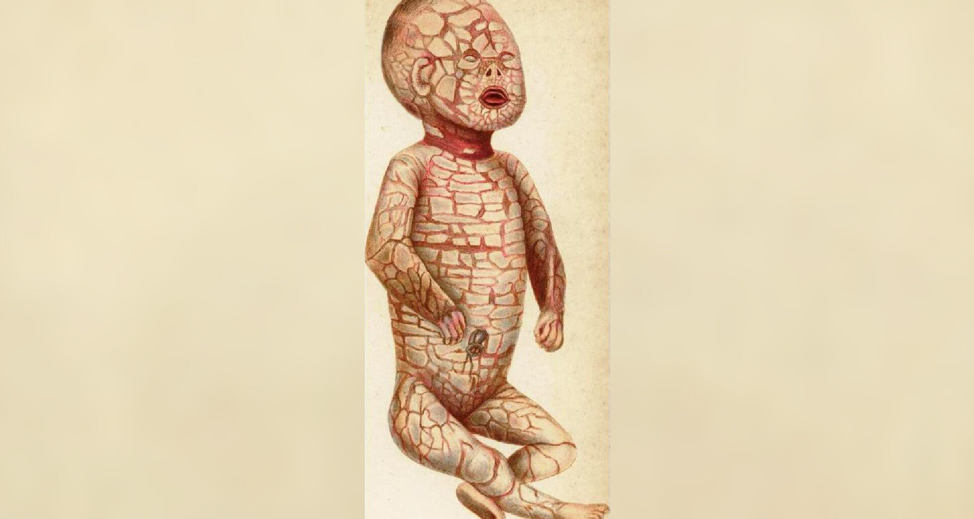an illustration of an infant with cracked scaly skin
