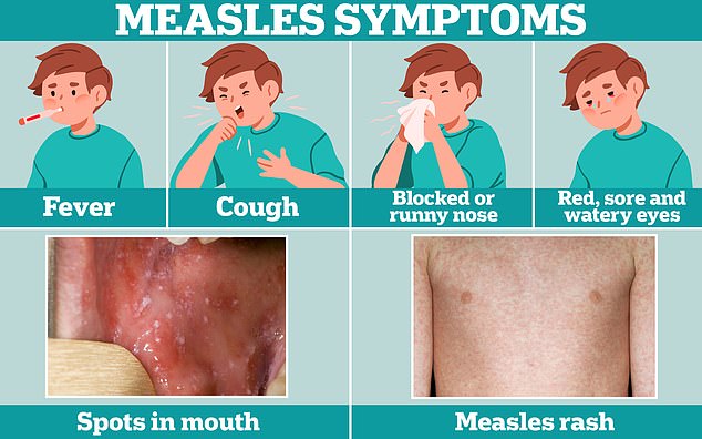 Cold-like symptoms, such as a fever, cough and a runny or blocked nose, are usually the first signal of measles
