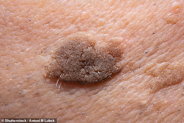 Because these patches are benign and don¿t become cancerous, removal is usually considered cosmetic and not funded by the NHS