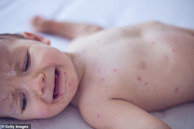 Measles is the most infectious disease in the world, with an infected person able to pass the disease to nine out of 10 people exposed who are unvaccinated