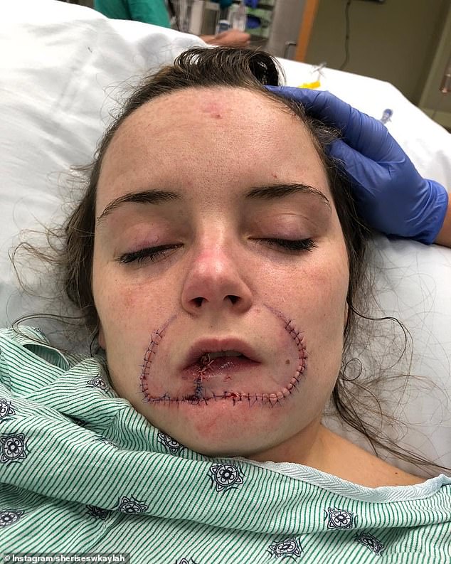 The pair had been dating for a year when Hayes decided to call it quits on their romance, saying Fleury had become abusive. But when attempting to break up with him, he leant in to kiss her and refused to let go, even when she pulled away, leading him to tear away 85 per cent of her lip. Pictured after having emergency surgery
