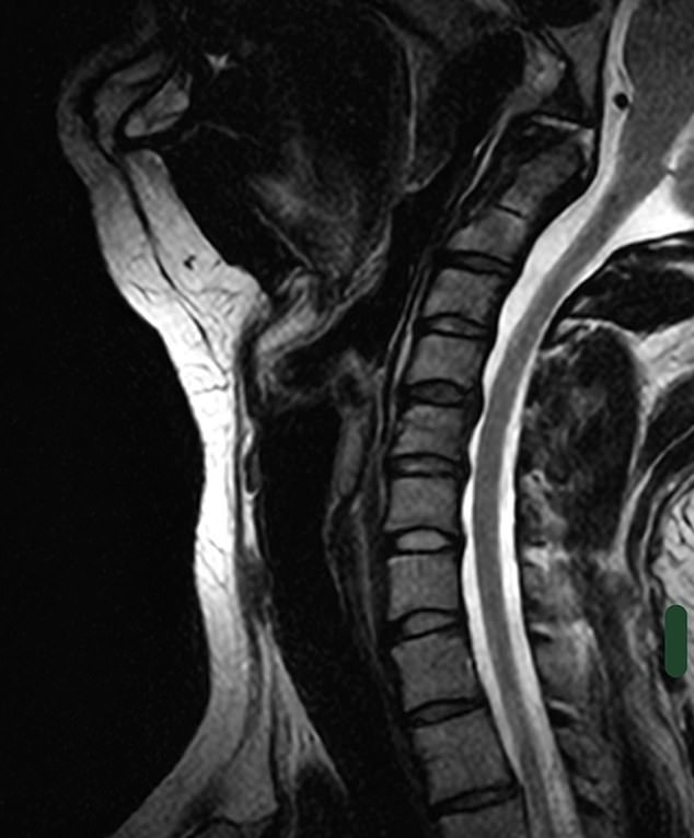 Pictured: an MRI scan showing Ms Moore's neck. If her condition is If left untreated, it can cause rapid neurological decline, chronic fatigue, paralysis and, in the absolute worst case scenario, even life-threatening internal decapitation