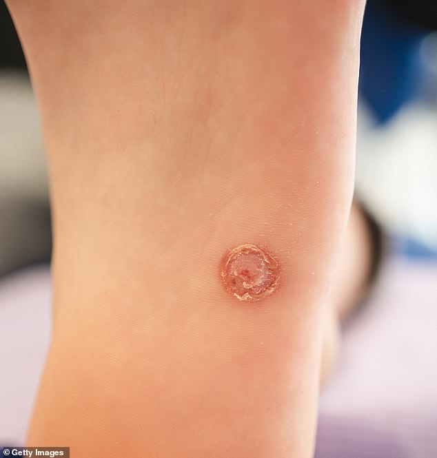 Around 10 per cent of the population (30 per cent among children and young adults) are living with a wart