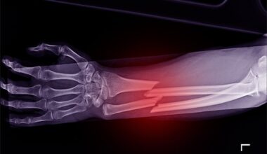 Campaigners say the figures, taken from independent research commissioned by the Royal Osteoporosis Society (ROS), are just one indicator of the toll osteoporosis is taking on the UK economy. Pictured: File photo