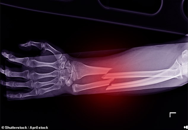 Campaigners say the figures, taken from independent research commissioned by the Royal Osteoporosis Society (ROS), are just one indicator of the toll osteoporosis is taking on the UK economy. Pictured: File photo