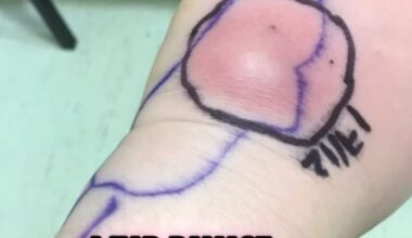 The infection in Ms Pohl's hand spread and is thought to have triggered her CRPS
