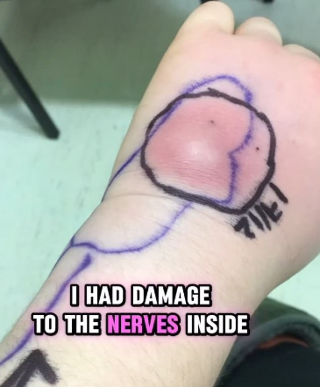The infection in Ms Pohl's hand spread and is thought to have triggered her CRPS