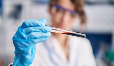 A simple blood test can tell which patients will rapidly develop severe Alzheimer’s, a study reveals