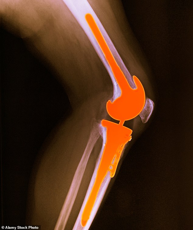 Patients with a confirmed nickel or cobalt allergy should avoid standard cobalt-chromium orthopaedic implants