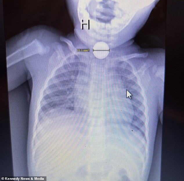 Button batteries contain a mix of corrosive chemicals that create a chemical reaction when swallowed. Pictured: A button batter lodged in a child's throat