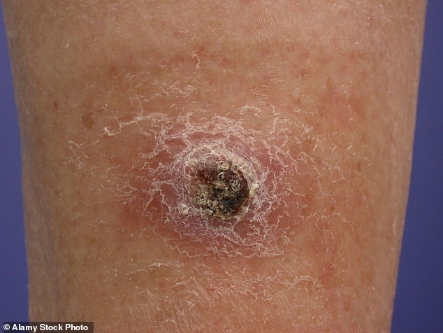 Squamous cell carcinomas – SCCs – may begin as red, scaly patches but can ulcerate, become lumpy, painful and weepy. They are increasingly common