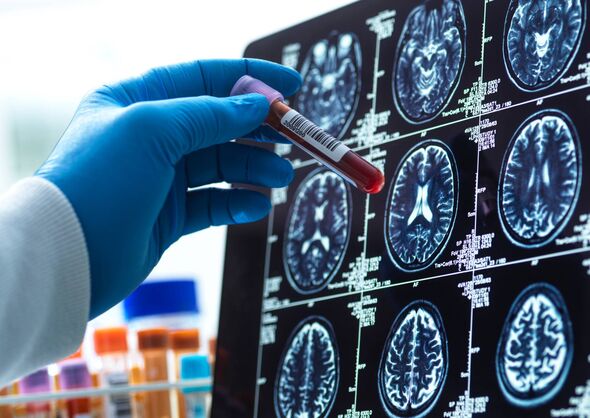 A blood test for Alzheimer’s 