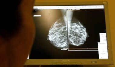 Wits researchers discover unique breast cancer genes in black women - SABC News